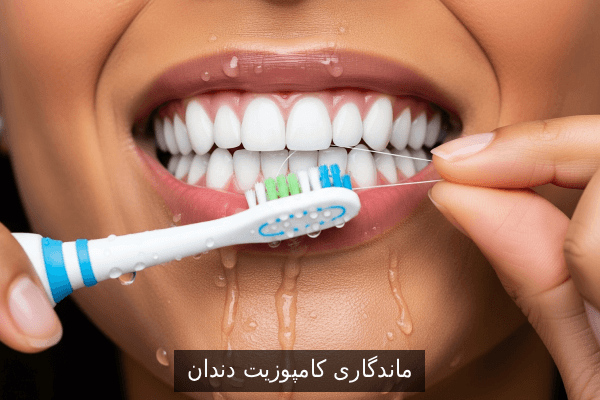ماندگاری کامپوزیت دندان