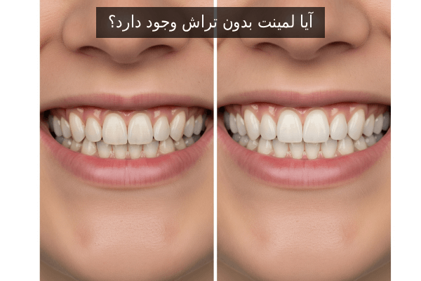 آیا لمینت بدون تراش وجود دارد؟