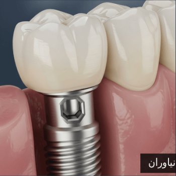 ایمپلنت نیاوران
