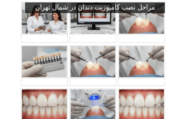 مراحل نصب کامپوزیت دندان در شمال تهران
