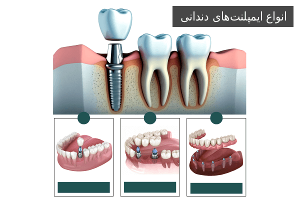 انواع ایمپلنتهای دندانی