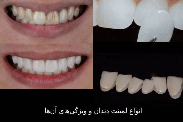 انواع لمینت دندان و ویژگیهای آنها