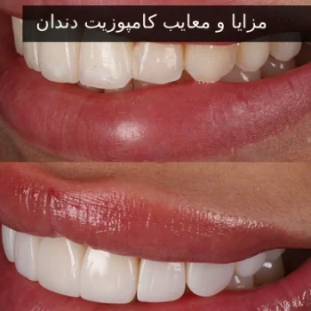 مزایا و معایب کامپوزیت دندان