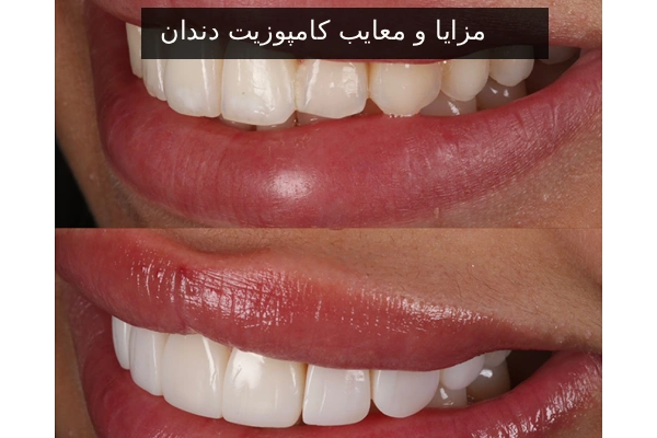 مزایا و معایب کامپوزیت دندان