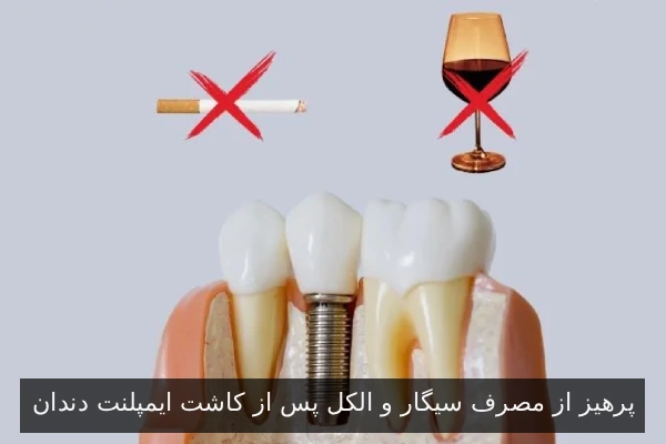 پرهیز از مصرف سیگار و الکل پس از کاشت ایمپلنت دندان