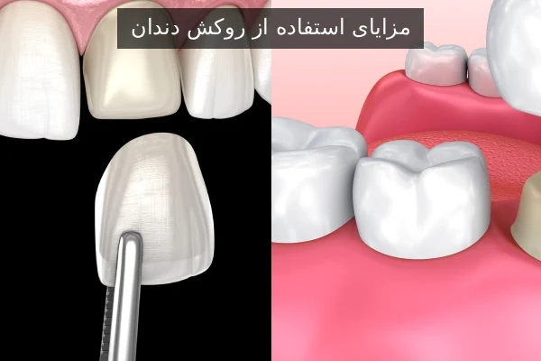 مزایای استفاده از روکش دندان