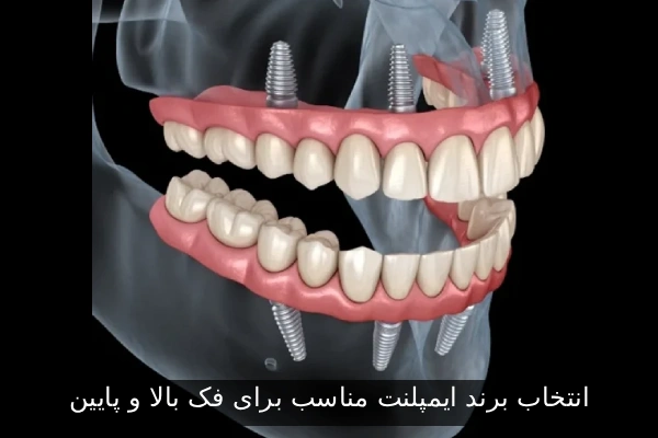 انتخاب برند ایمپلنت مناسب برای فک بالا و پایین