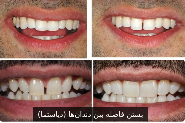 بستن فاصله بین دندانها (دیاستما)