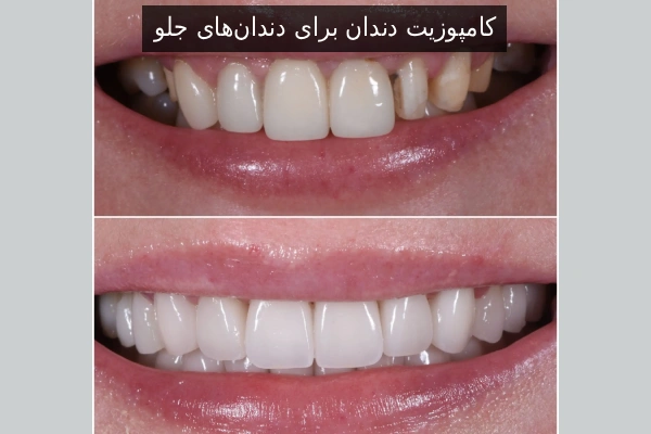 Dental Composite for Front Teeth