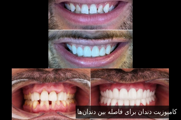 Dental Composite for Gaps Between Teeth