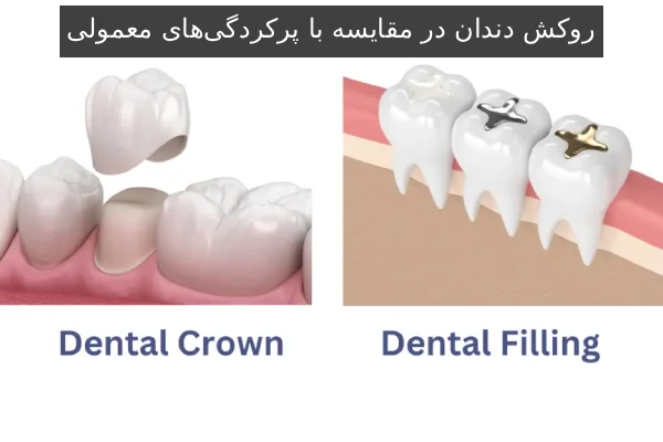 روکش دندان در مقایسه با پرکردگی‌های معمولی