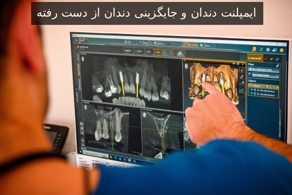 ایمپلنت دندان و جایگزینی دندان از دست رفته