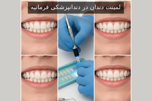 لمینت دندان در دندانپزشکی فرمانیه
