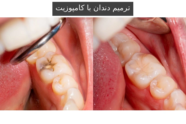ترمیم دندان با کامپوزیت: مزایا و معایب