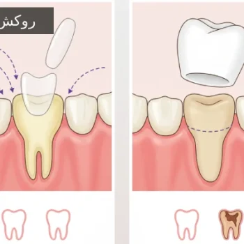 روکش دندان