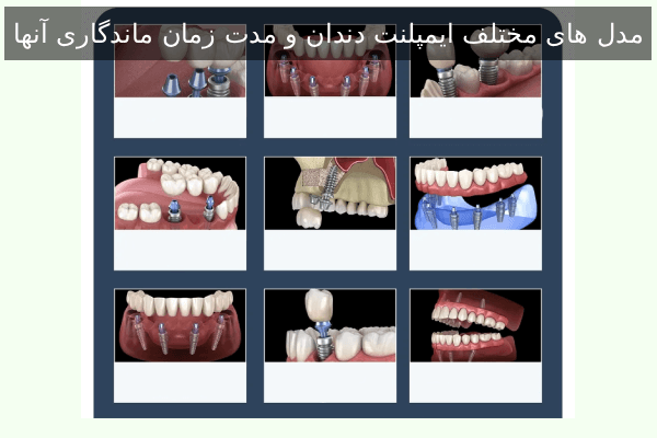 مدل های مختلف ایمپلنت دندان و مدت زمان ماندگاری آنها