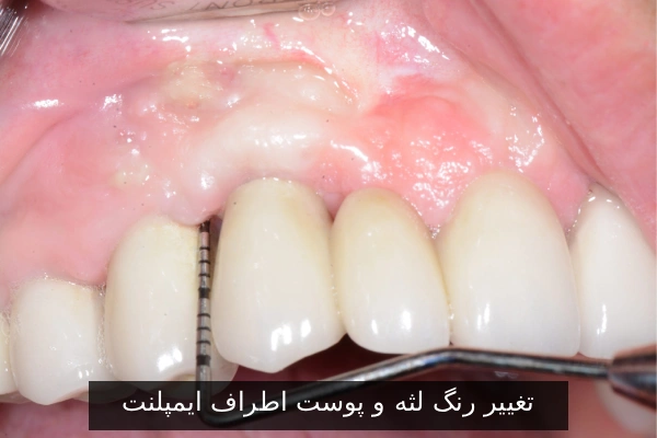 تغییر رنگ لثه و پوست اطراف ایمپلنت