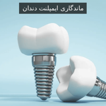 ماندگاری ایمپلنت دندان