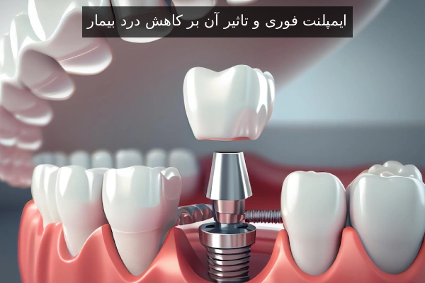 ایمپلنت فوری و تاثیر آن بر کاهش درد بیمار