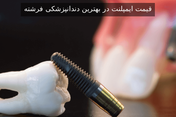 قیمت ایمپلنت در بهترین دندانپزشکی فرشته
