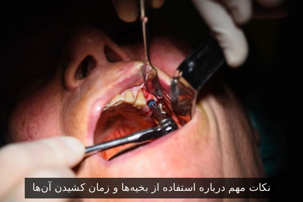 نکات مهم درباره استفاده از بخیهها و زمان کشیدن آنها