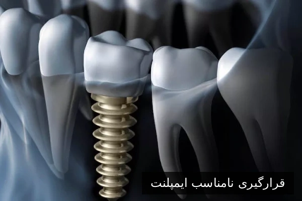 قرارگیری نامناسب ایمپلنت