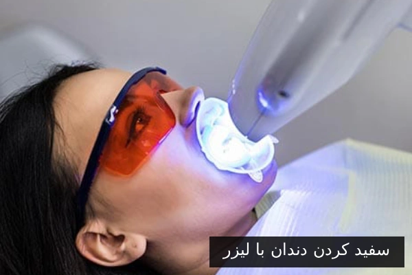 سفید کردن دندان با لیزر: کارایی و مزایا