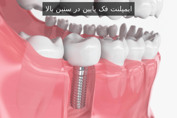 ایمپلنت فک پایین در سنین بالا