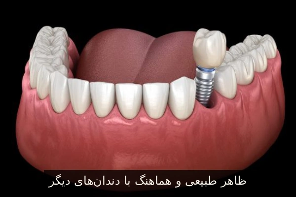 ظاهر طبیعی و هماهنگ با دندانهای دیگر