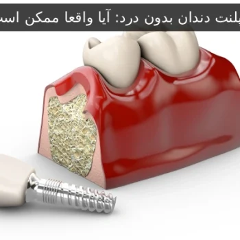 ایمپلنت دندان بدون درد: آیا واقعا ممکن است؟
