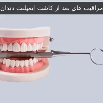 مراقبت‌ های بعد از کاشت ایمپلنت دندان
