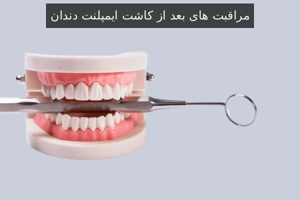مراقبت های بعد از کاشت ایمپلنت دندان