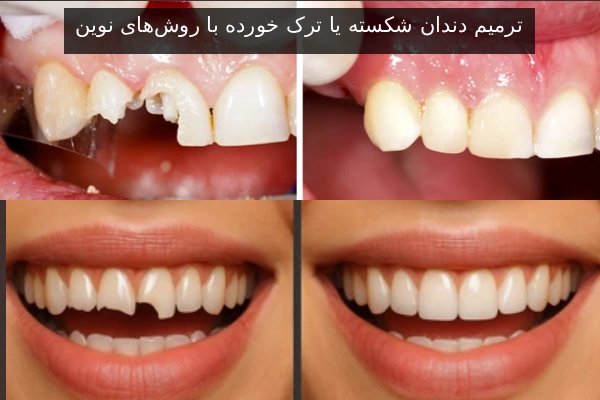 ترمیم دندان شکسته یا ترک خورده با روشهای نوین