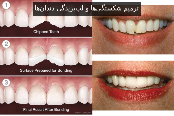 Repairing Fractures and Chipped Teeth