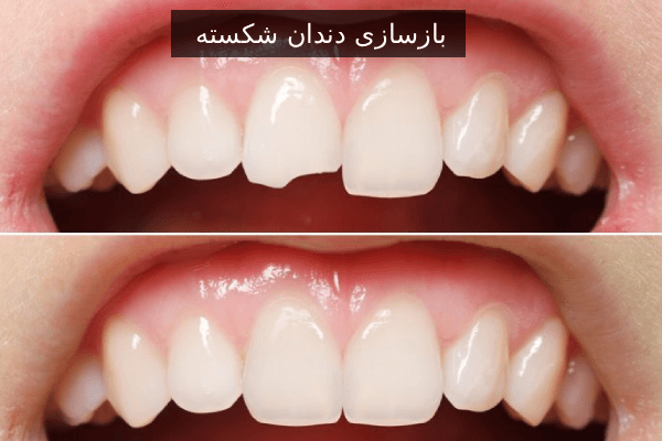 بازسازی دندان شکسته