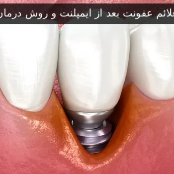 علائم عفونت بعد از ایمپلنت و روش درمان