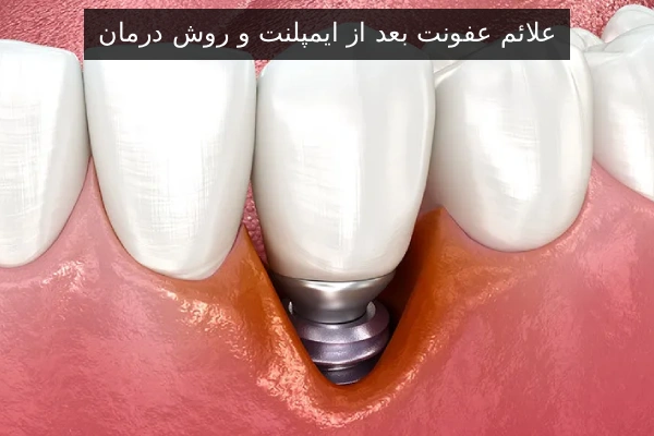 علائم عفونت بعد از ایمپلنت و روش درمان