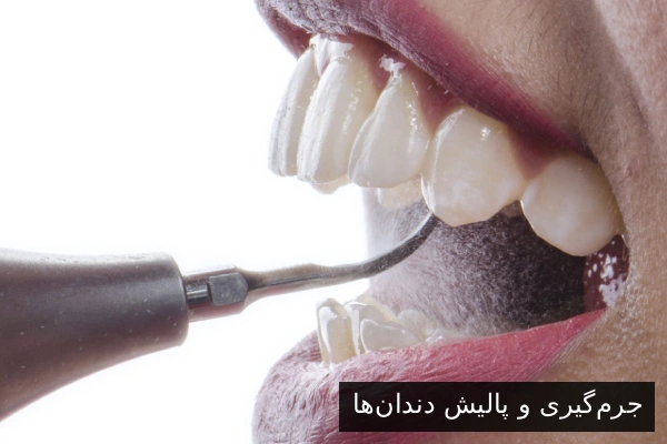 جرمگیری و پالیش دندانها