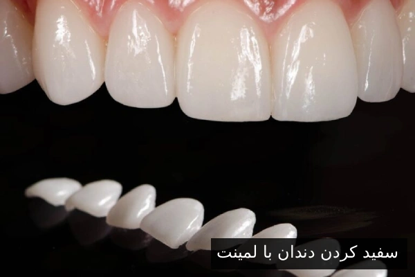 سفید کردن دندان با لمینت