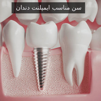 سن مناسب ایمپلنت دندان