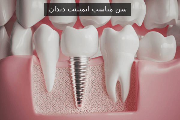 سن مناسب ایمپلنت دندان