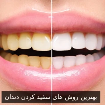بهترین روش‌ های سفید کردن دندان