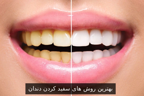 بهترین روش های سفید کردن دندان