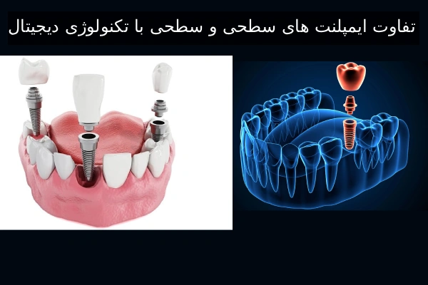 تفاوت ایمپلنت های سطحی و سطحی با تکنولوژی دیجیتال