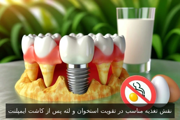 نقش تغذیه مناسب در تقویت استخوان و لثه پس از کاشت ایمپلنت