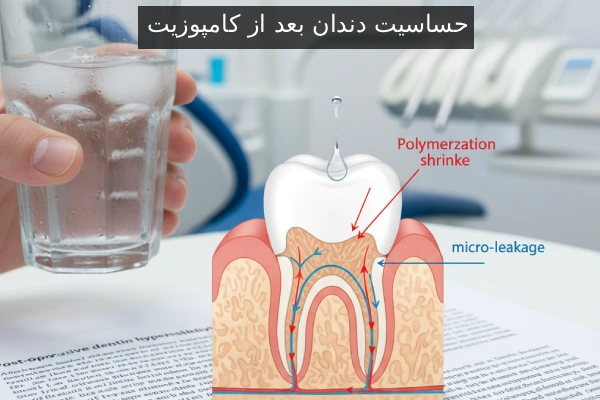 حساسیت دندان بعد از کامپوزیت