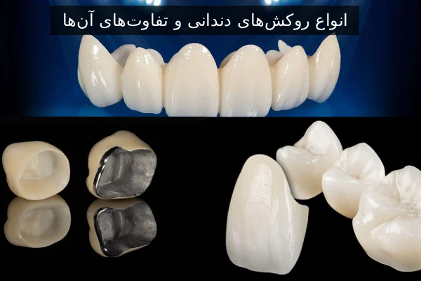 انواع روکش‌های دندانی و تفاوت‌های آن‌ها