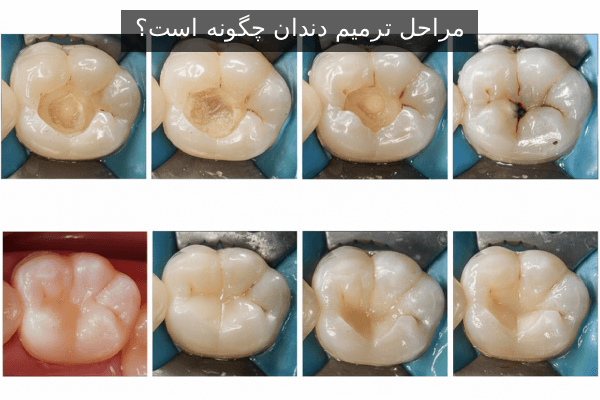 مراحل ترمیم دندان چگونه است؟
