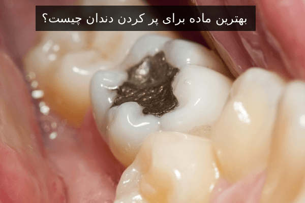 بهترین ماده برای پر کردن دندان چیست؟