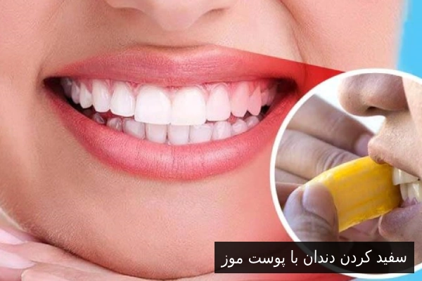 سفید کردن دندان با پوست موز